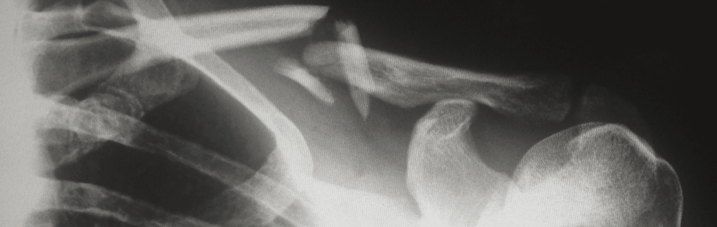 x-ray showing a broken collar bone